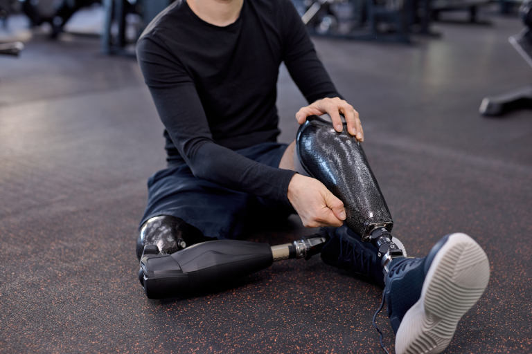 Enhancing Rehabilitation with AI-Powered Prosthetics